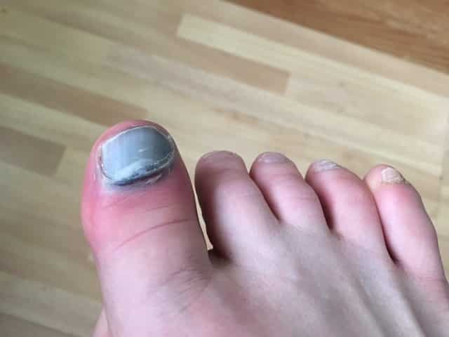 My poor toe