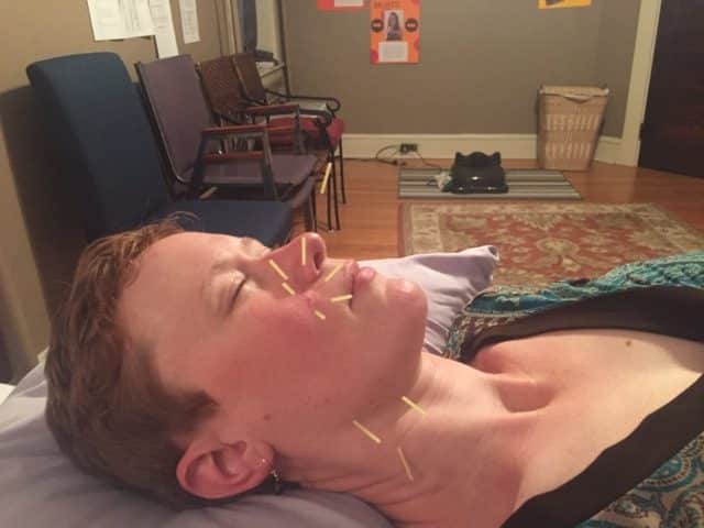 Acupuncture = Beauty
